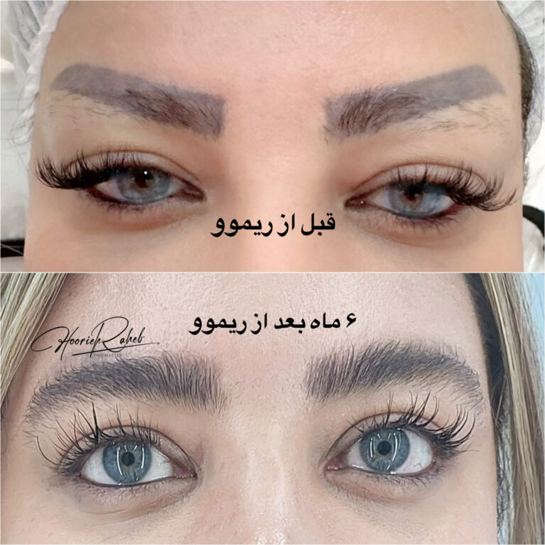 تنها مرکز ریموو تخصصی در شیراز با مرکز میکرو حوریه راحب