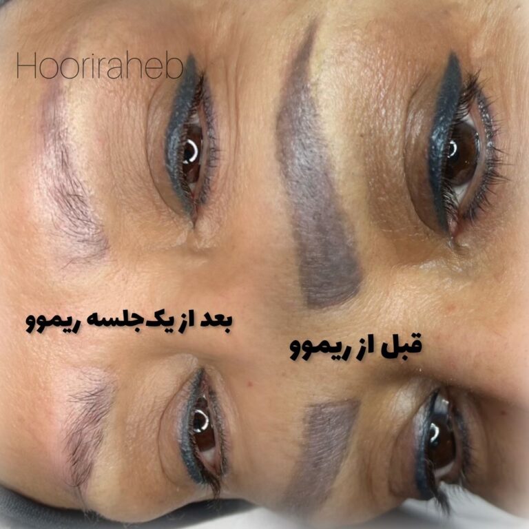 ریموو تخصصی تتو قدیمی با حوریه راحب