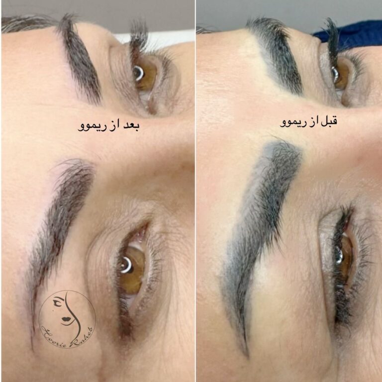 ریموو و احیاء ابرو در شیراز