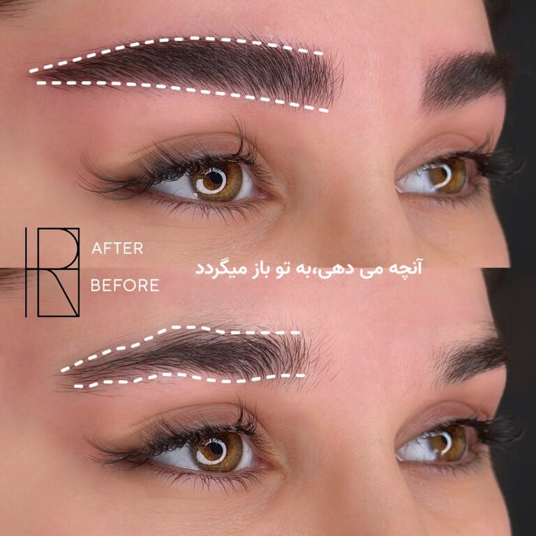 ترکیب لیفت ابرو و خطوط مویی میکروبلیدینگ با خواب کاملاً طبیعی در رشت