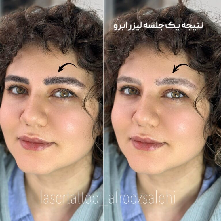 مقایسه قبل و بعد اجرای میکروبلیدینگ نچرال توسط مرکز افروز صالحی در کرج.