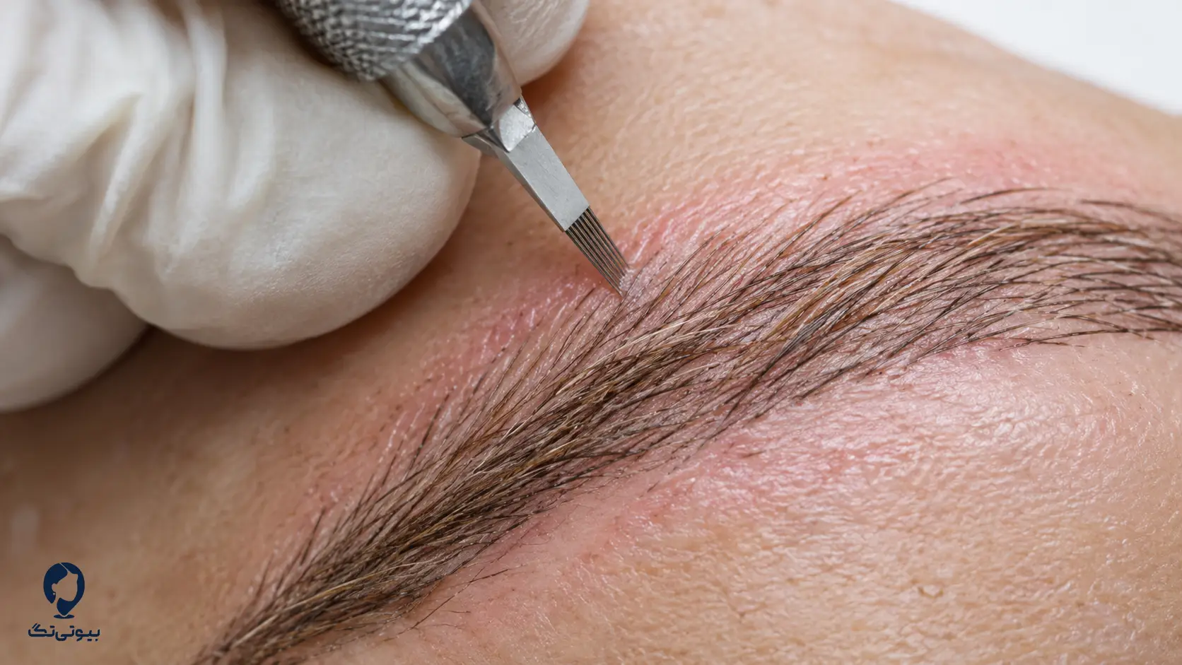 عمق کار میکروبلیدینگ در لایه سطحی پوست